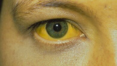 Mắt bị vàng là gì? Nguyên nhân nào khiến mắt bị vàng? | Medlatec