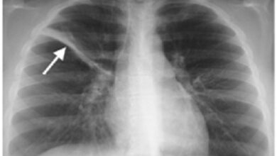 Rốn phổi tăng đậm là bệnh gì