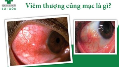 Viêm thượng củng mạc: Triệu chứng và cách điều trị – Bệnh Viện Mắt Sài Gòn